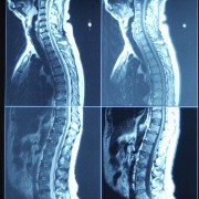 Scoliosis related image